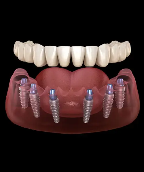Protesis Dentales Hibridad Ds dental 1