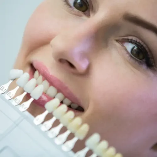 fabricación de carillas dentales Ds dental